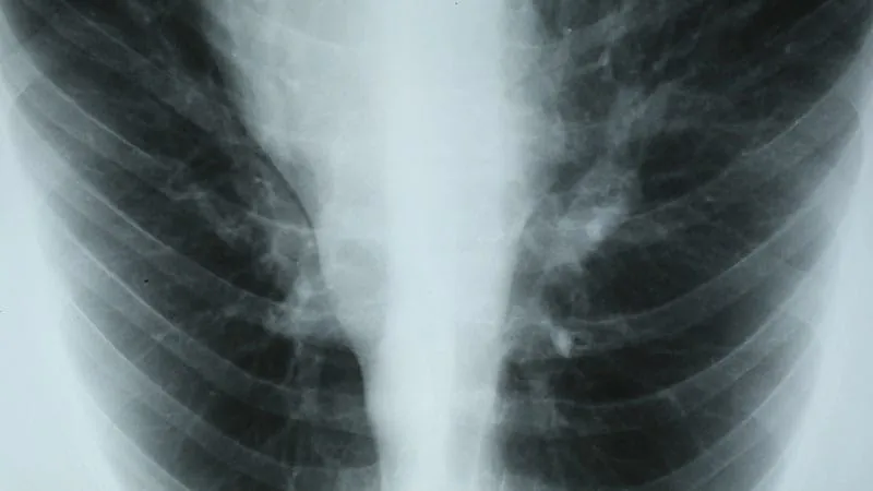 Combo therapy beats colistin alone for tough drug-resistant infections