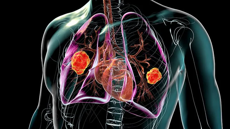 Mucor PCR testing shows promise — but only with the right clinical context