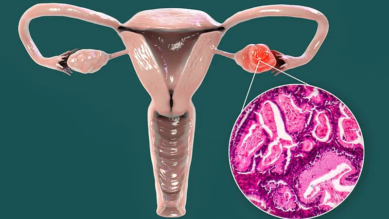 Mirvetuximab doubles tumor response in ovarian cancer but misses the survival mark