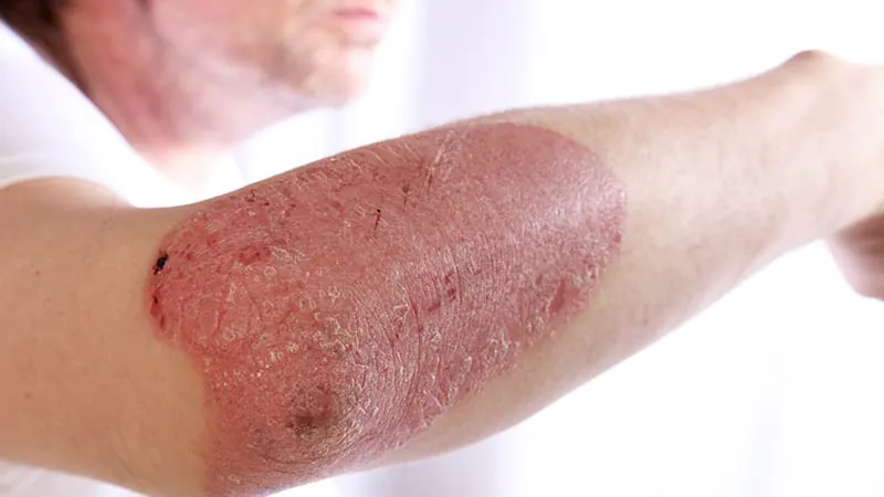 Gut biotics show promise as an add-on therapy for psoriasis