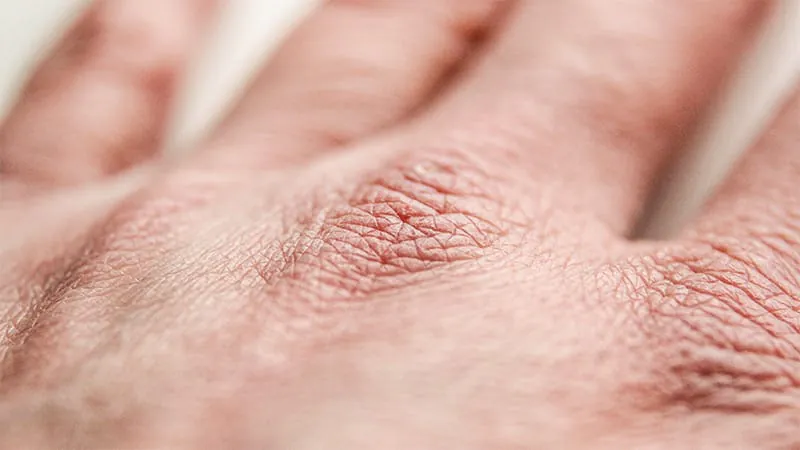 Dupilumab restores skin nerve density in atopic dermatitis patients to healthy levels