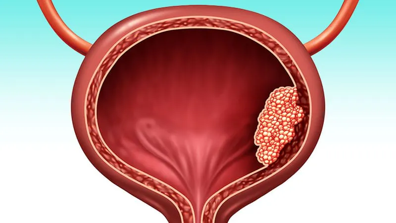 Bladder preservation in muscle-invasive bladder cancer: A new era on the horizon