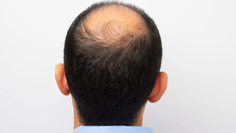 Teen hair loss is more common than you think — and doctors keep missing it