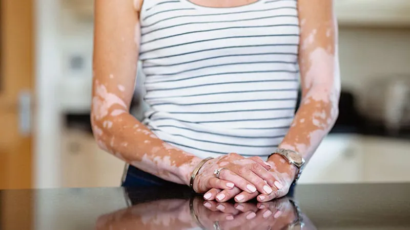 Vitiligo's hidden toll: The mental health crisis hiding in plain sight
