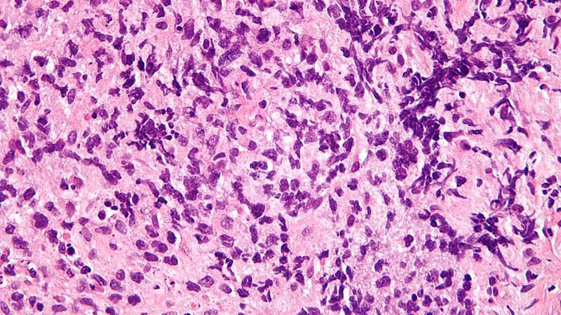 Chemo-free epcoritamab shows strong results in elderly, frail lymphoma patients