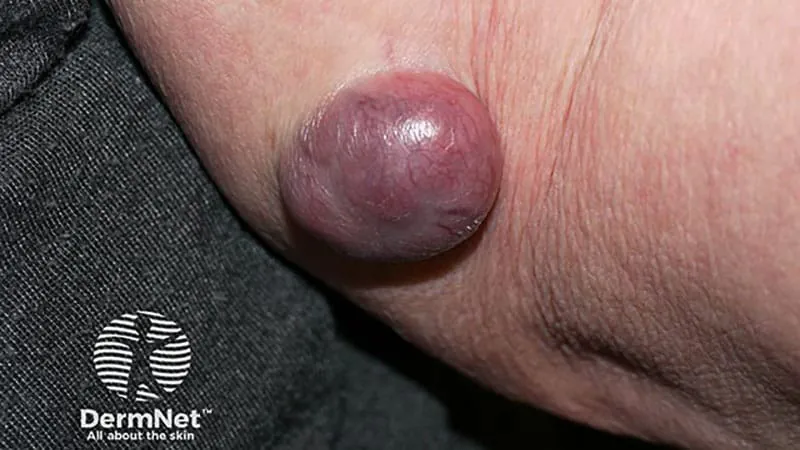 Merkel cell carcinoma carries a heavier burden than many other cancers, study finds