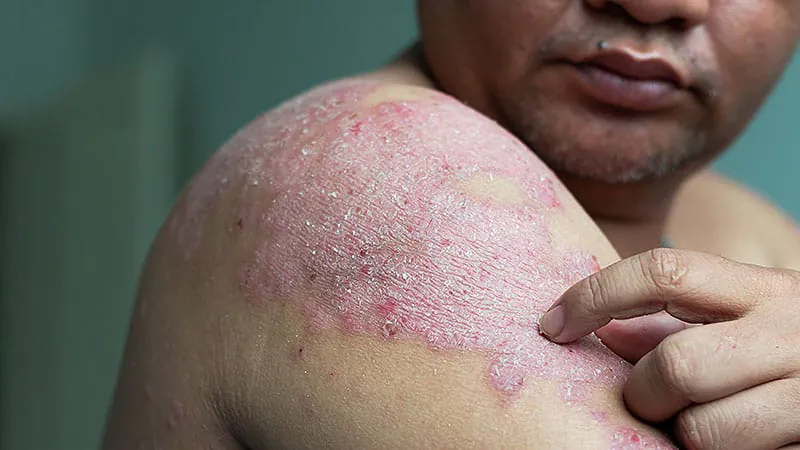 Early biologics for psoriasis: why dermatologists should stop saving the best for last