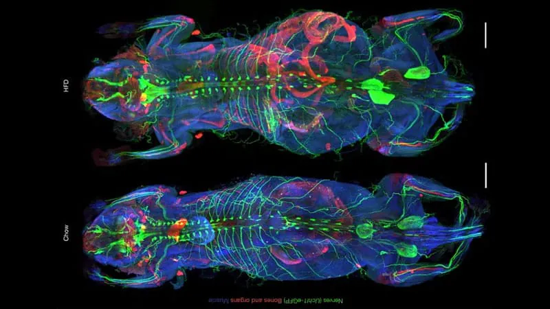 AI tool reveals hidden, whole-body nerve damage caused by obesity