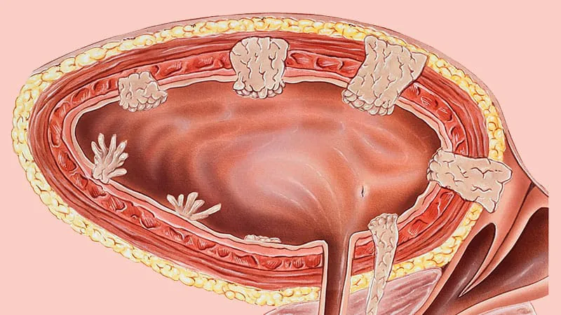EV + pembrolizumab outperforms chemo in real-world bladder cancer treatment