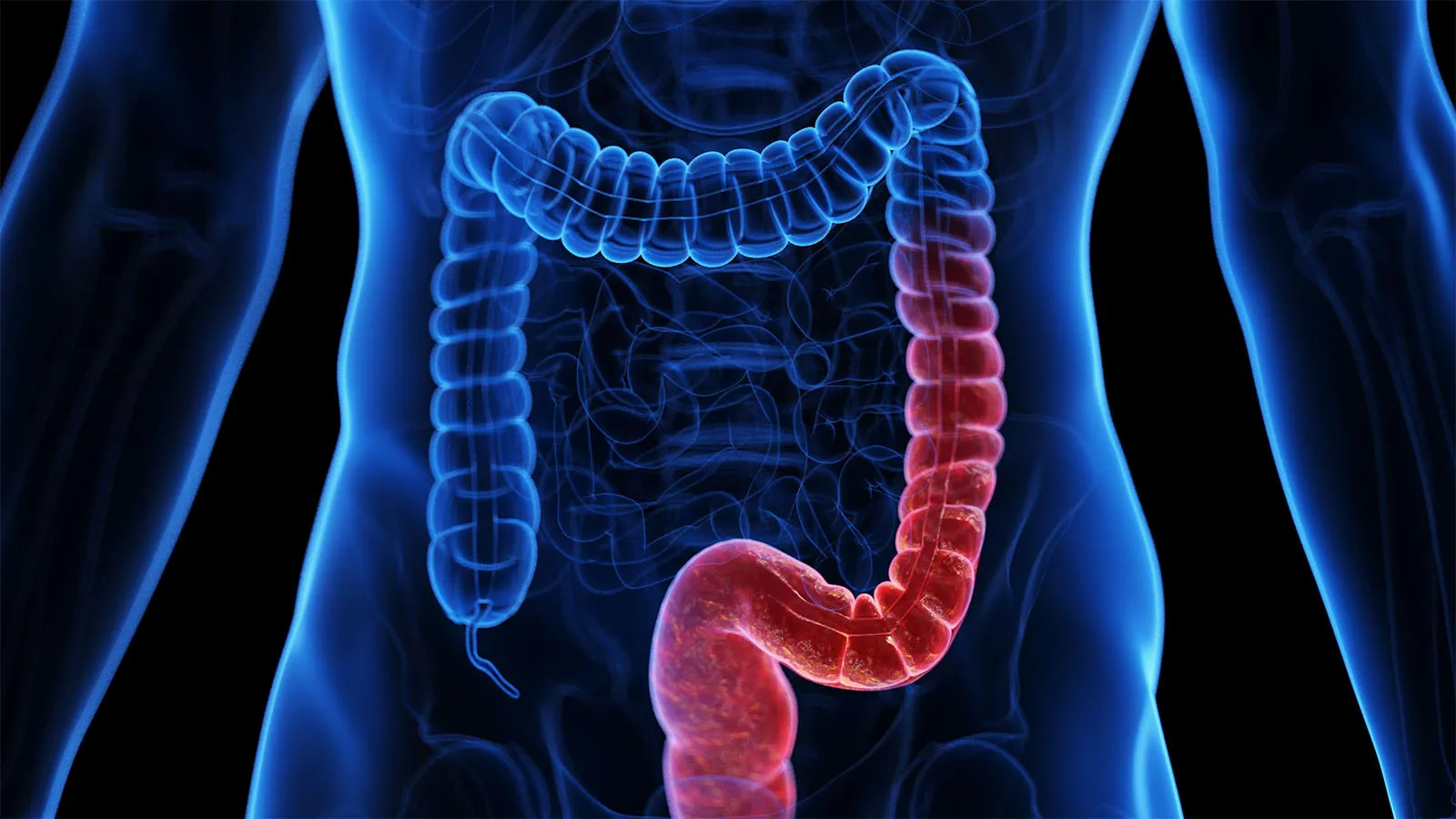 Higher doses of JAK and IL-23 inhibitors show better UC remission rates — but it's complicated