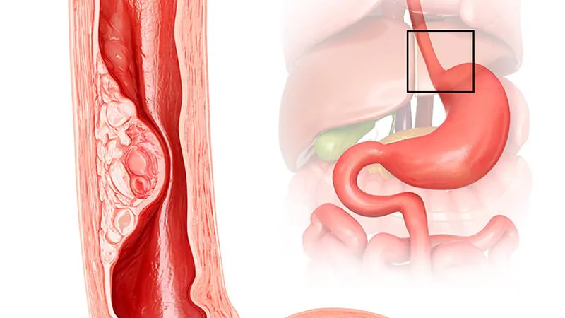 AI outperforms junior endoscopists in detecting early esophageal cancer