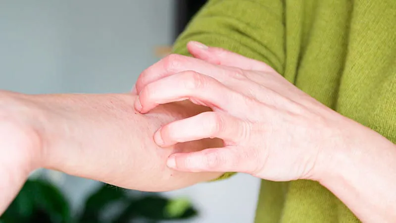 Abrocitinib outperforms dupilumab in achieving complete skin clearance and itch relief for atopic dermatitis