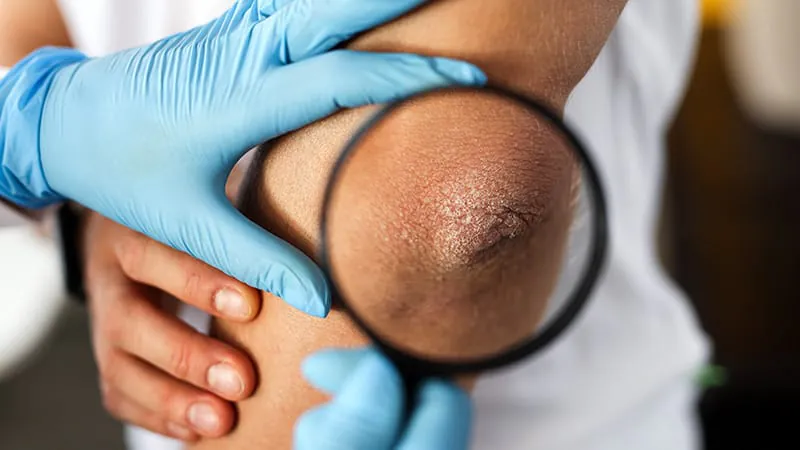 GLP-1 drugs may fight skin disease directly — not just through weight loss