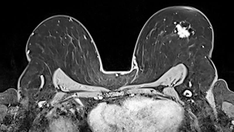 Breast MRI signal could sharpen cancer risk predictions for BRCA mutation carriers