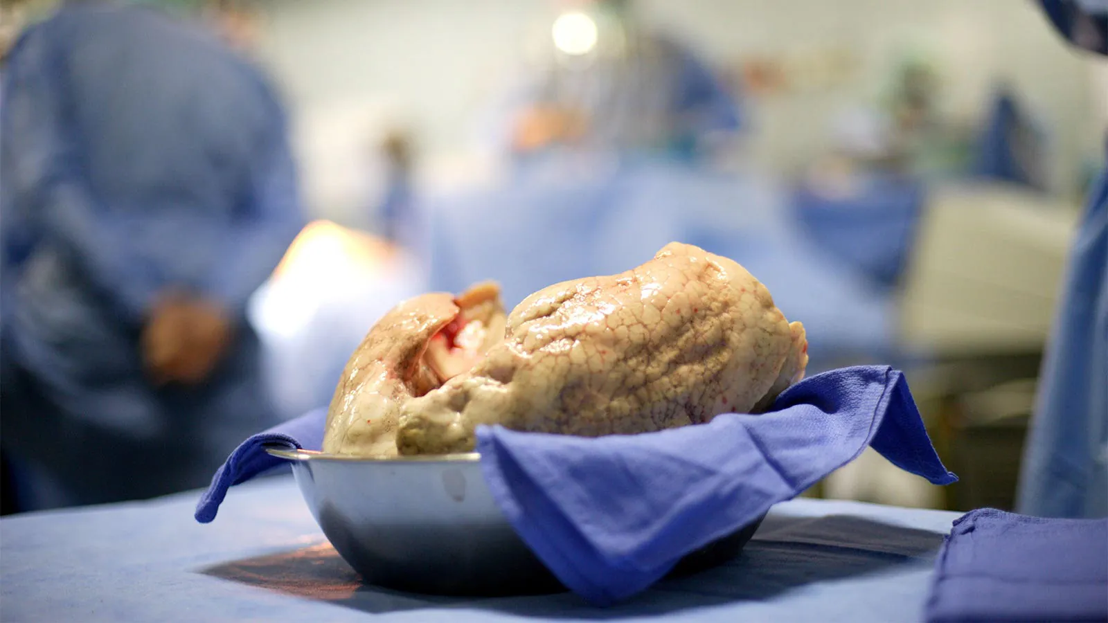Lung transplant shows striking survival benefit in select metastatic lung cancer patients
