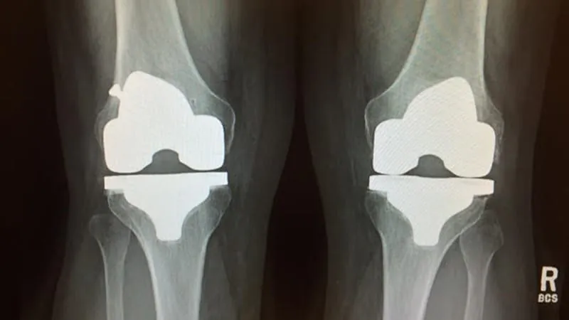 A "dental" CT setting turns out to be the secret weapon for clearer knee implant scans