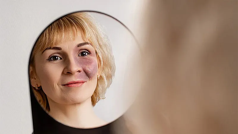 New laser combo clears stubborn port-wine birthmarks with high patient satisfaction