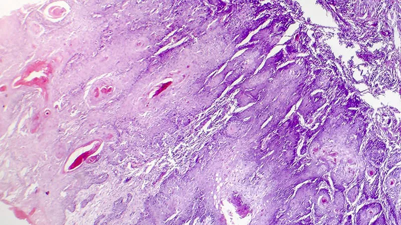 New consensus guidelines clarify when and how to image skin cancer patients