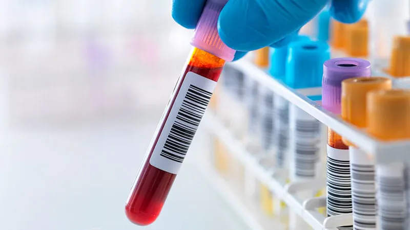 A blood protein signal could flag Sjögren disease up to 14 years early