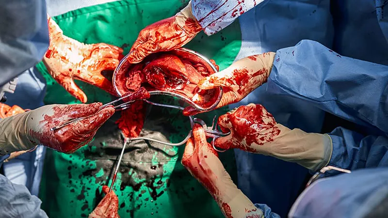 Organ transplant recipients face double the cancer death risk, study finds