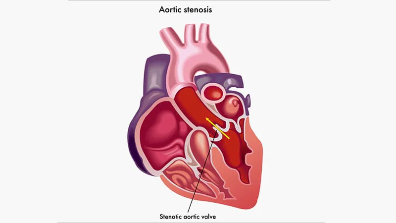 Early TAVI beats watchful waiting — in outcomes and costs