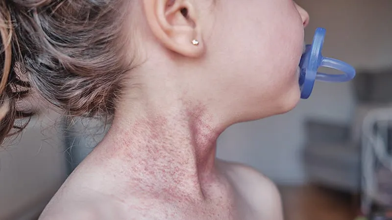 More early-life infections = higher eczema risk in kids