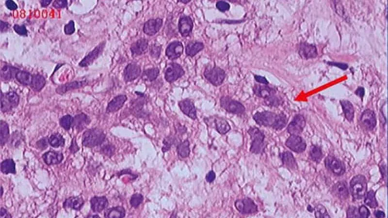 Dual immunotherapy combo more than doubles breast cancer treatment response rates