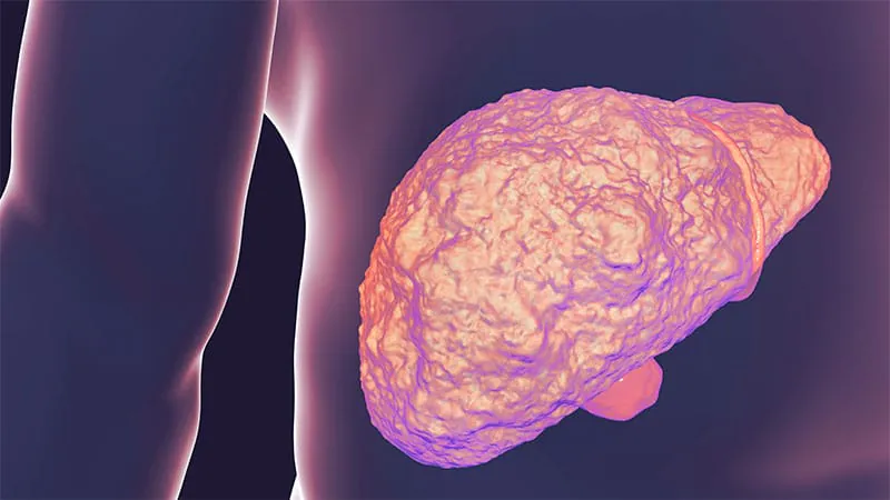 Beta-blockers cut mortality risk in cirrhosis beyond just preventing bleeds
