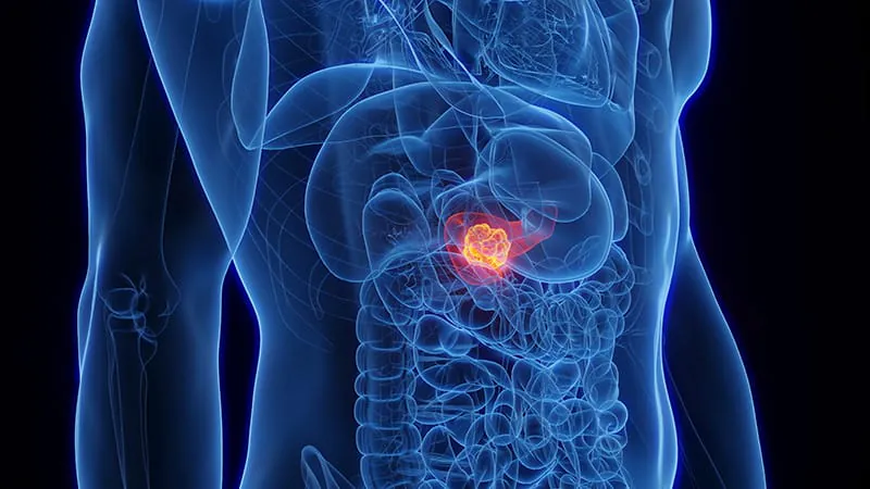 Particle chemoradiotherapy outperforms standard treatments in locally advanced pancreatic cancer