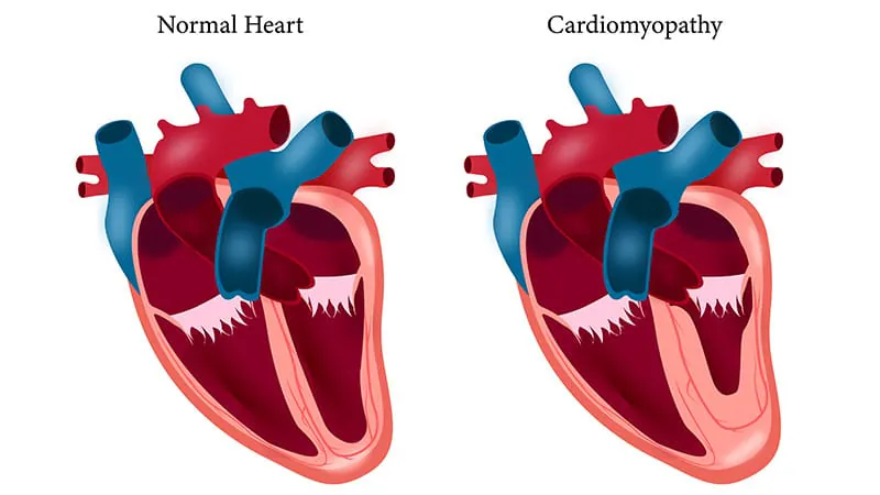 Heart muscle irregularity in dilated cardiomyopathy doesn't raise clot risk, study finds