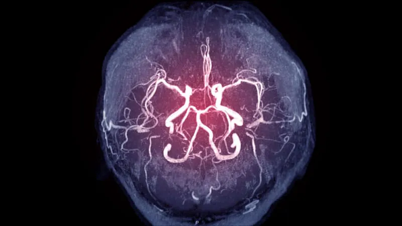 Blood thinners after stroke don't raise brain aneurysm rupture risk, study finds