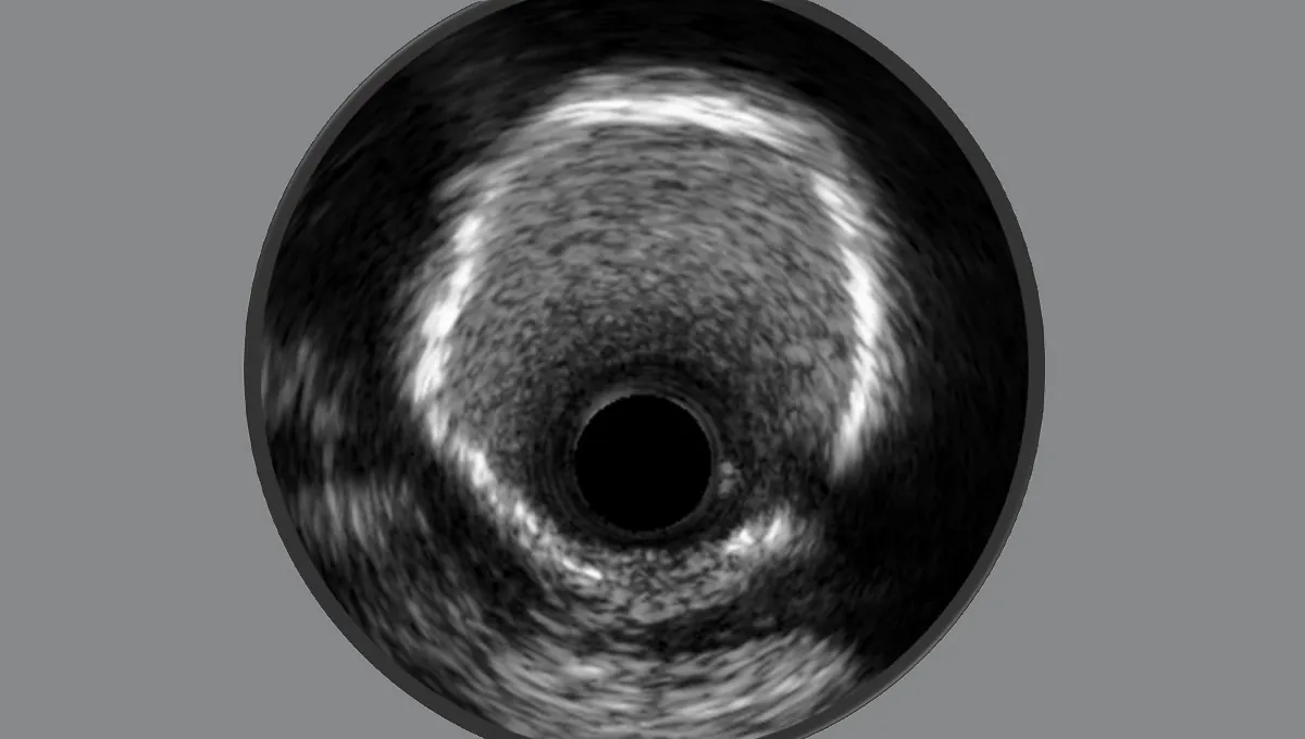 Michigan's quality-improvement push dramatically boosts imaging-guided heart procedures — for both men and women