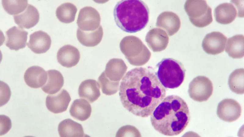 Acalabrutinib delivers durable survival gains in real-world CLL patients
