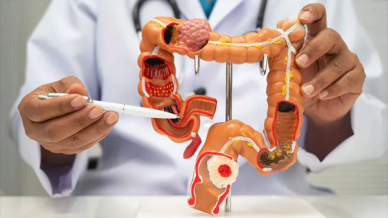 Metabolic syndrome dramatically raises colorectal cancer risk in young men