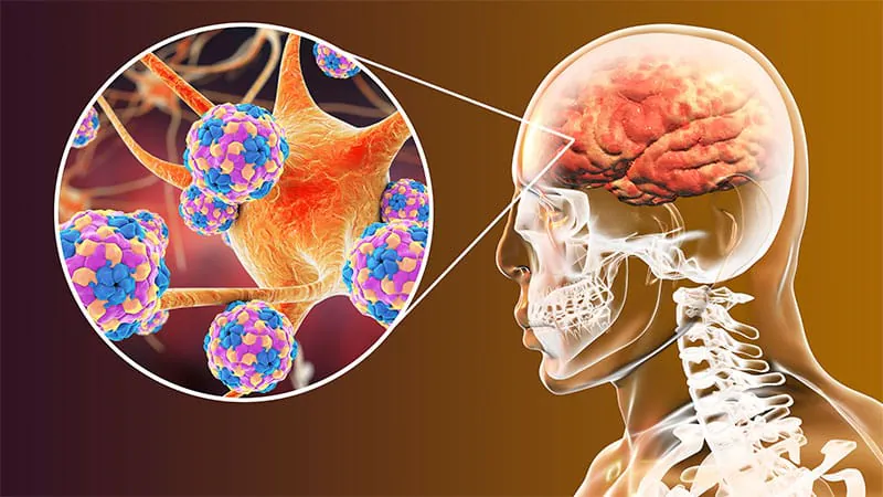 Surviving encephalitis raises long-term dementia risk across all ages