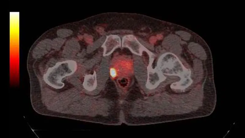 Where surgeons cut during prostate removal may determine hernia risk