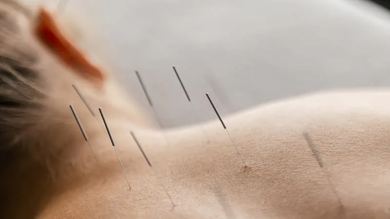 Acupuncture shows promise for IBS, but experts urge caution