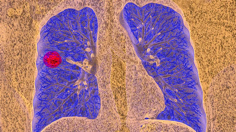 A simple reminder system could dramatically close the lung cancer screening gap
