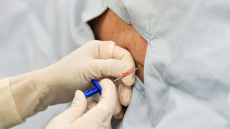 Epidurals in low-risk pregnancies linked to longer labor and more interventions
