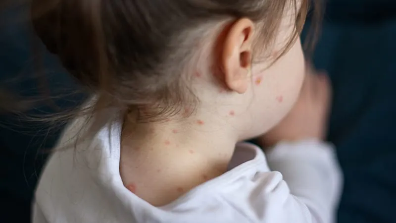 Chickenpox is making a comeback — and many doctors have never seen it