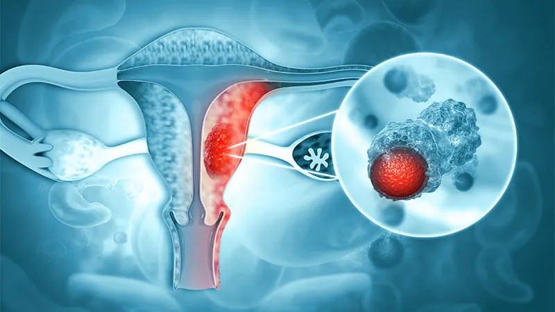 New Belgian algorithm brings molecular precision to endometrial cancer treatment decisions