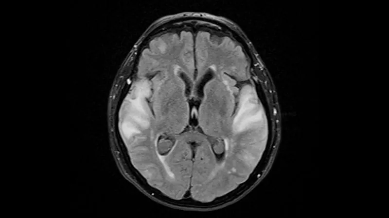 APOE ε4 gene flags lecanemab brain bleed risk — but can't predict who's actually in danger