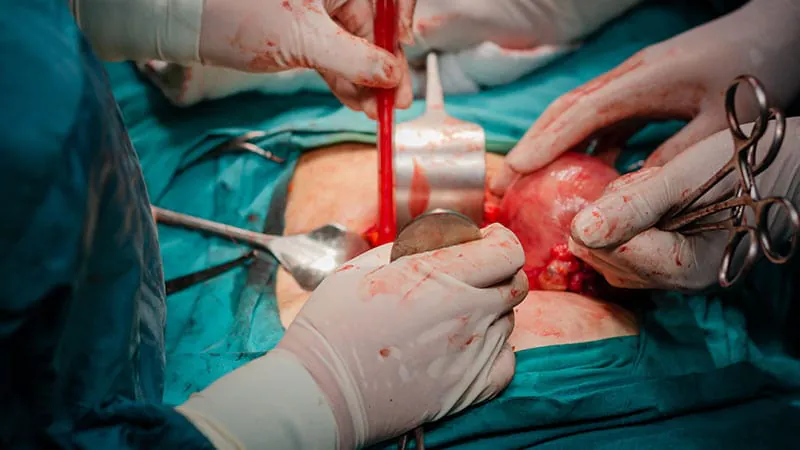 Opioid use disorder linked to higher risks and costs after hysterectomy