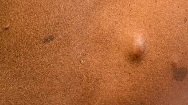 Cherry angiomas are an unrecognized vascular sign of neurofibromatosis type 1
