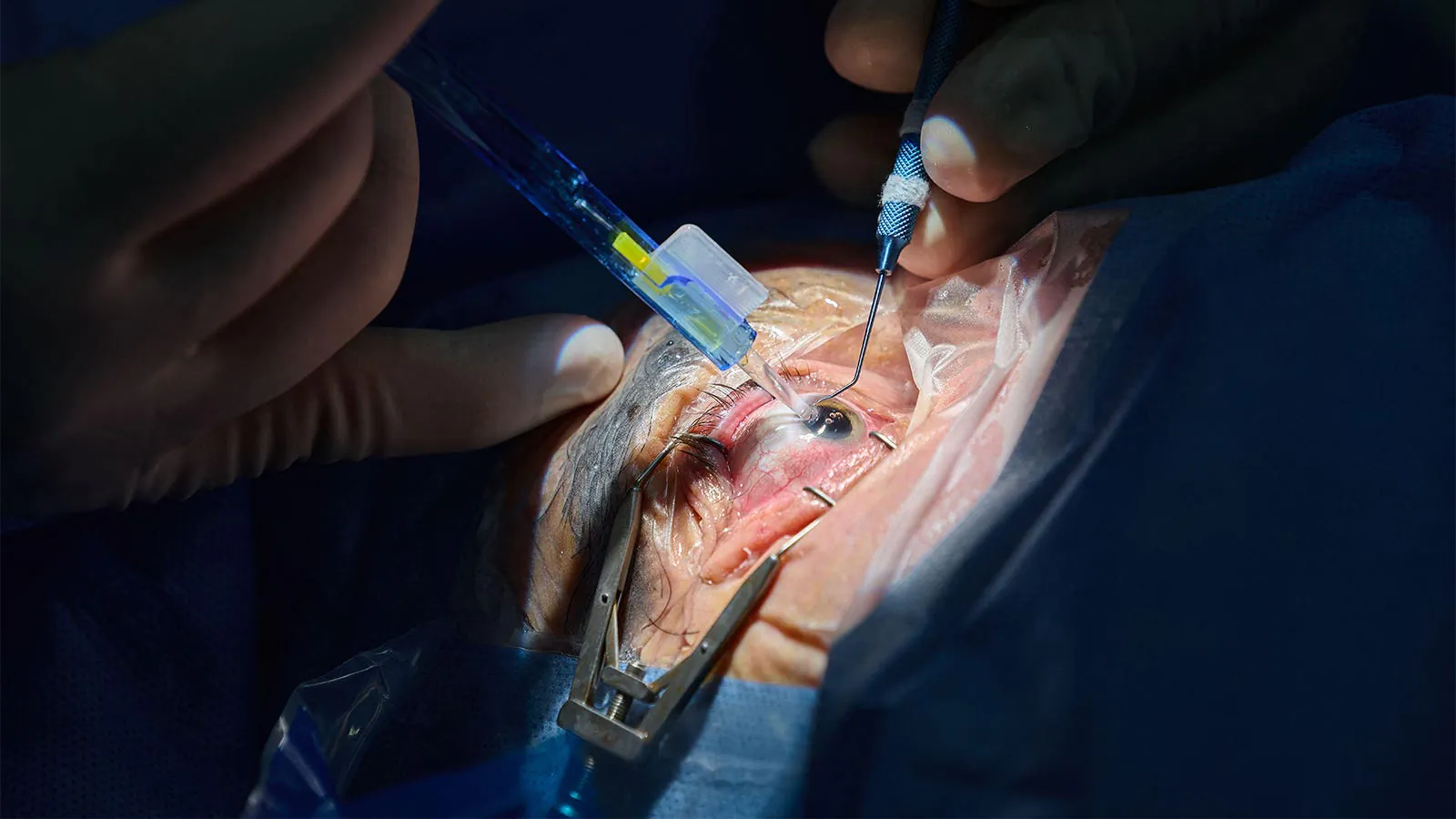As Medicare cuts cataract surgery pay, ophthalmologists are steering patients toward pricier laser procedures