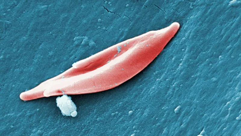 IV arginine falls short for sickle cell pain in major phase 3 trial