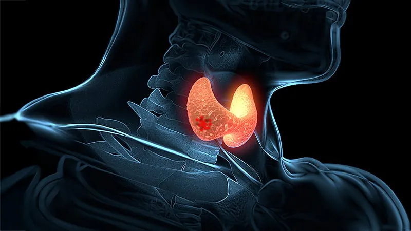 It's not your age — it's your genes: TERT variants drive thyroid cancer outcomes