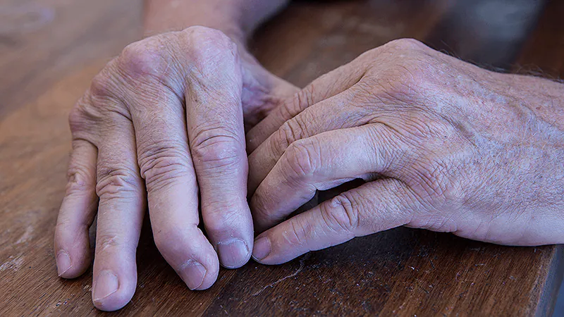 Double trouble for psoriatic arthritis: combining two targeted therapies shows promise