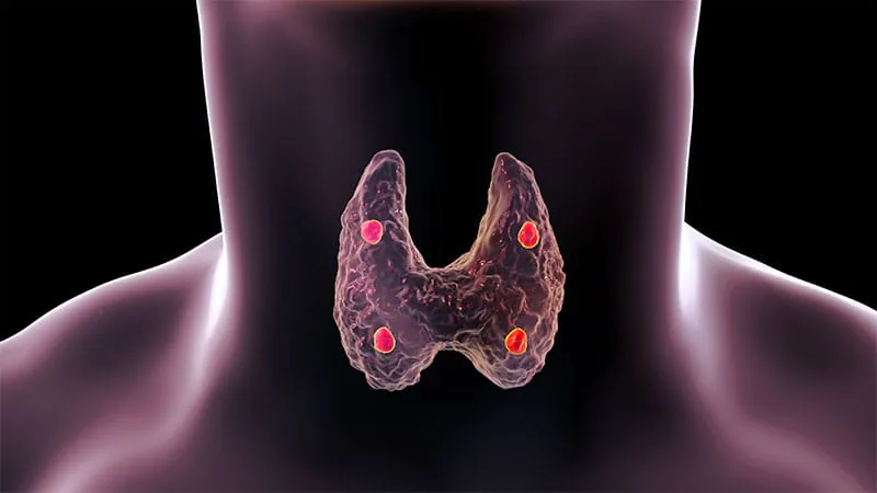 4D CT steps up when standard imaging falls short for parathyroid adenomas