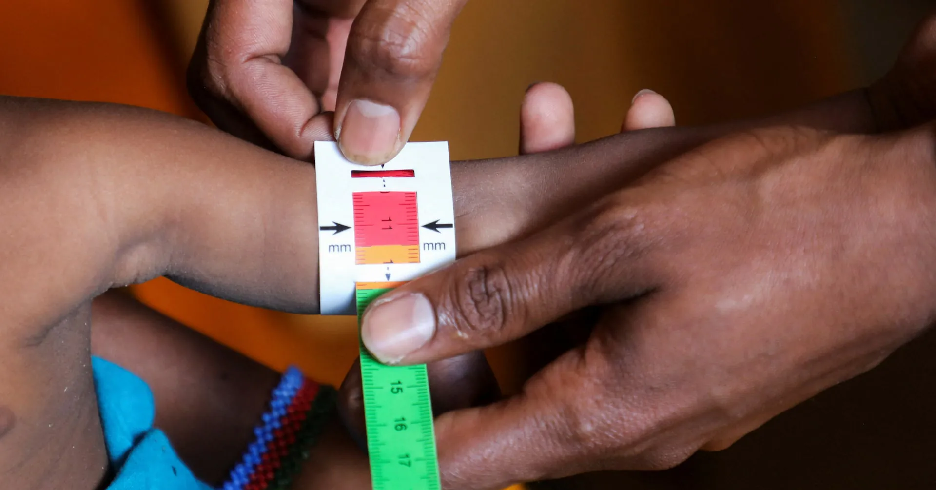 Somalia's child malnutrition crisis spirals as aid cuts shutter hundreds of health facilities